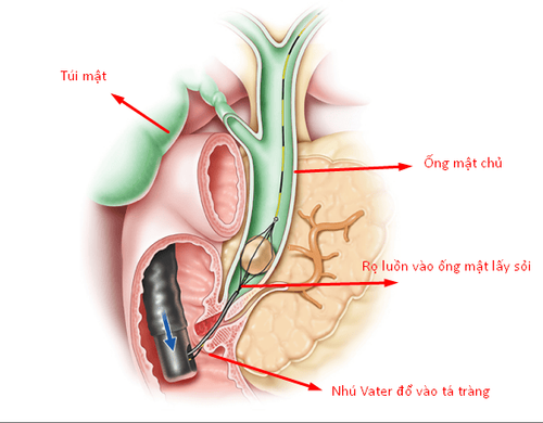 Nội soi ống tủy