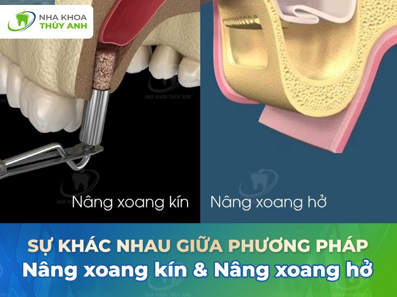 So sánh nâng xoang hở và nâng xoang kín