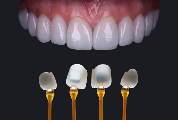 Veneer sứ