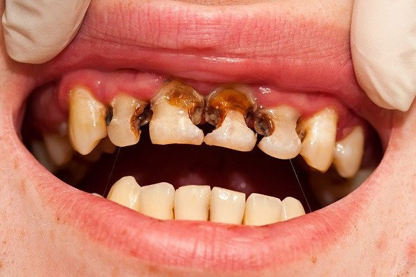 Răng sún ở trẻ em