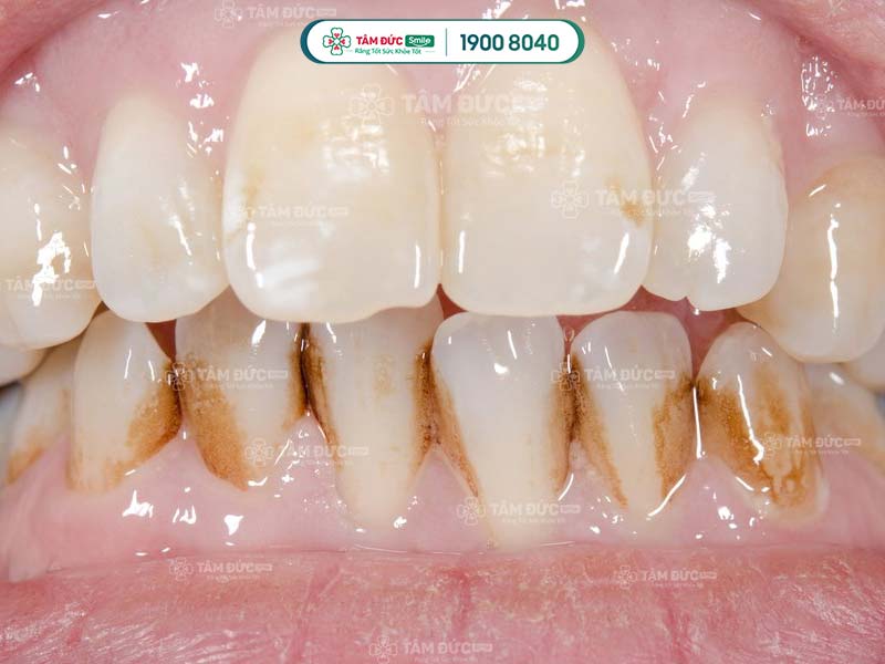 Cách trị răng ố vàng tại nha khoa