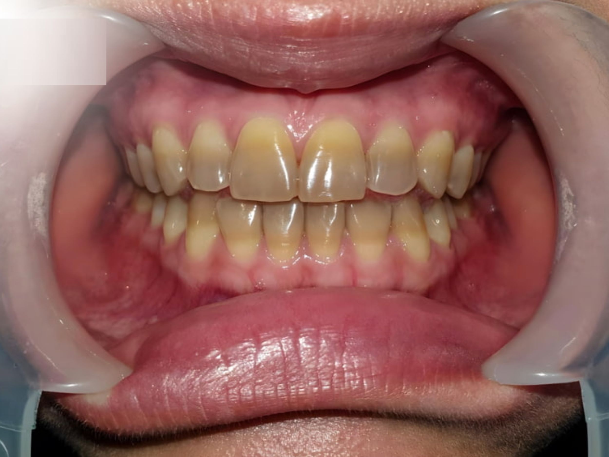 Dấu hiệu răng nhiễm sắc Tetracycline