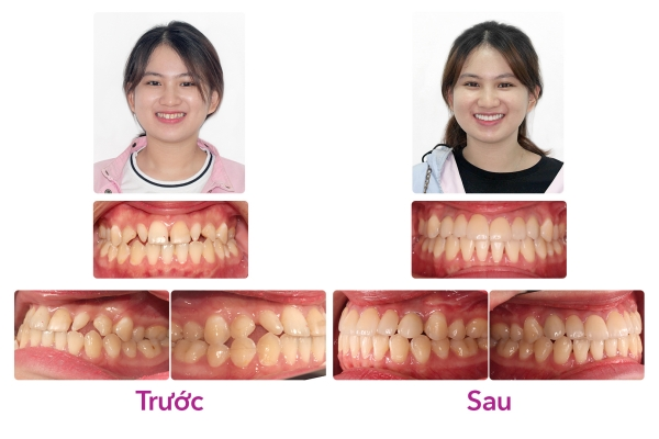 Bọc sứ thẩm mỹ