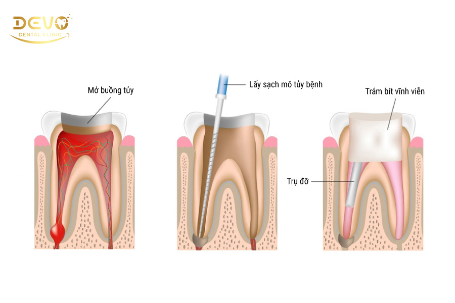 trám răng có cần lấy tủy không