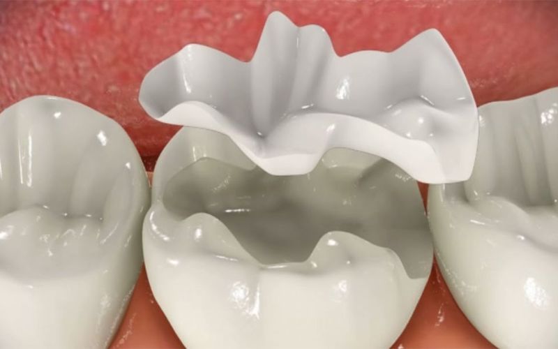 Quá trình thực hiện trám răng Overlay Sứ tại nha khoa