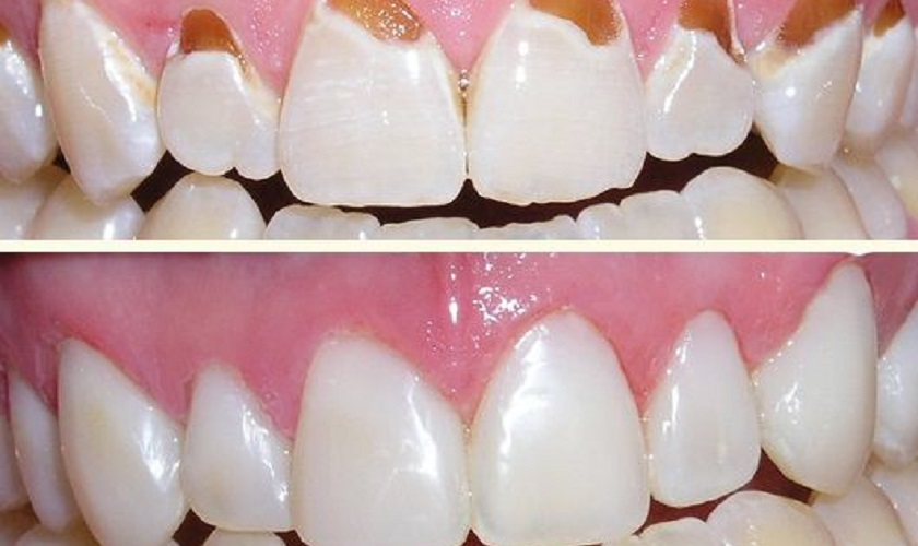 Trám răng thẩm mỹ