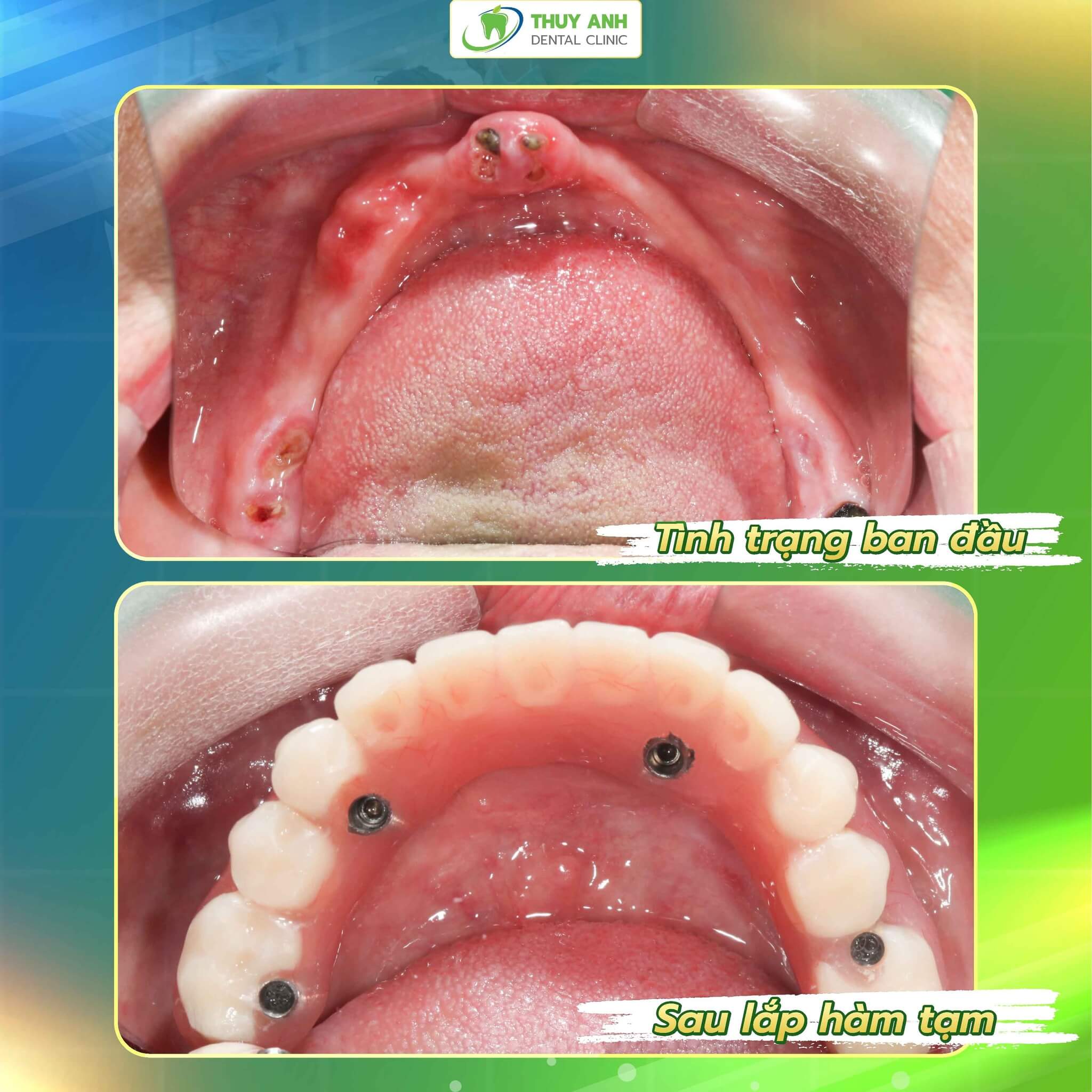 Cấy trụ implant vào xương hàm