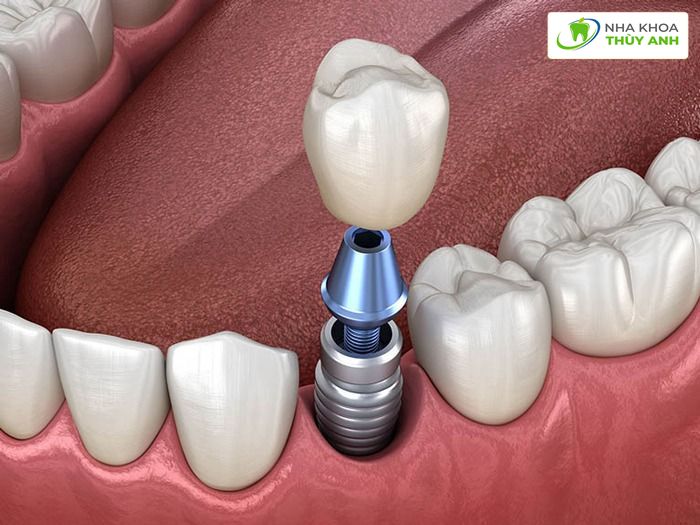 Lợi ích của trồng răng implant