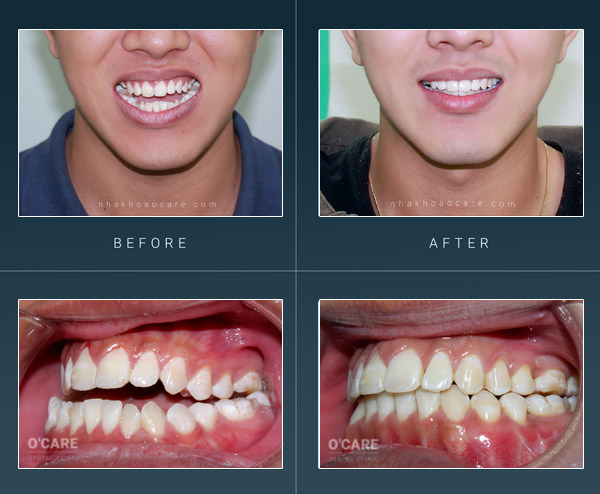 Niềng răng móm trước và sau