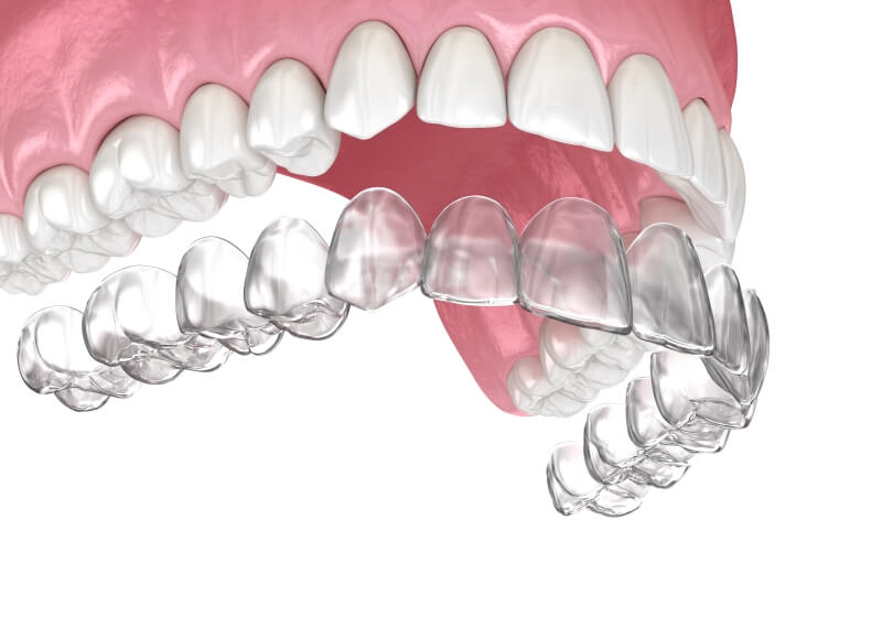 Ưu điểm của khay niềng trong suốt