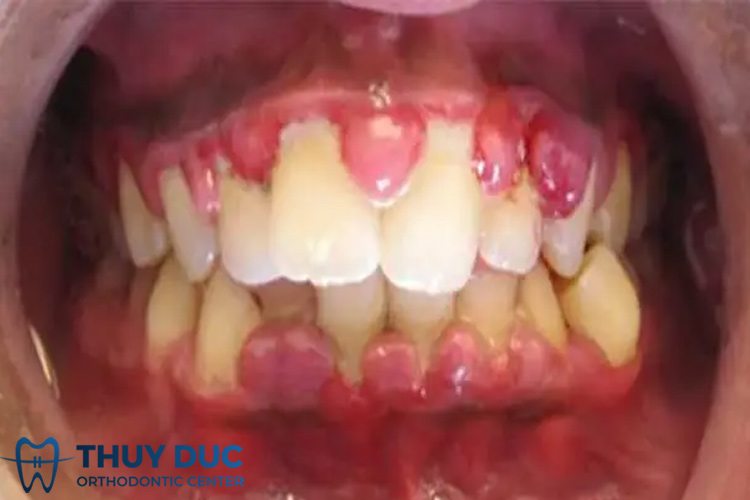 viêm nướu tuổi dậy thì