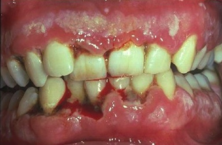 Hình ảnh viêm nướu tróc vảy