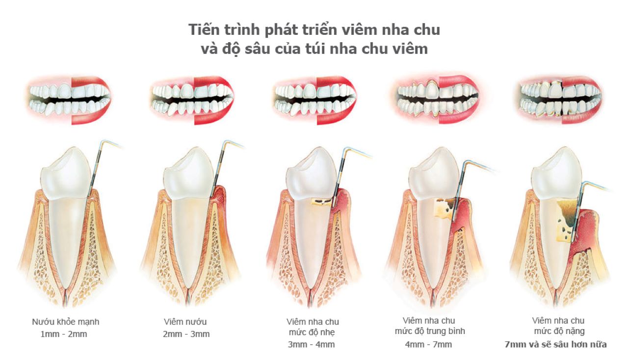 Triệu chứng viêm nướu và bệnh nha chu