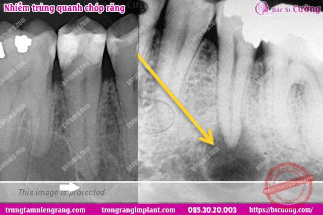 Hình ảnh viêm quanh chóp trên X-quang