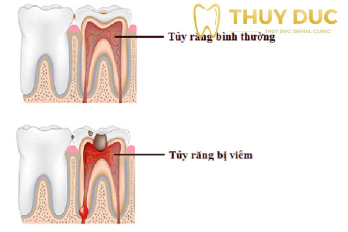 Viêm tủy răng