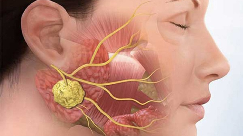 Viêm tuyến nước bọt do vi khuẩn