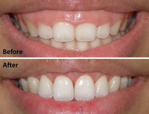 Cắt nướu thẩm mỹ