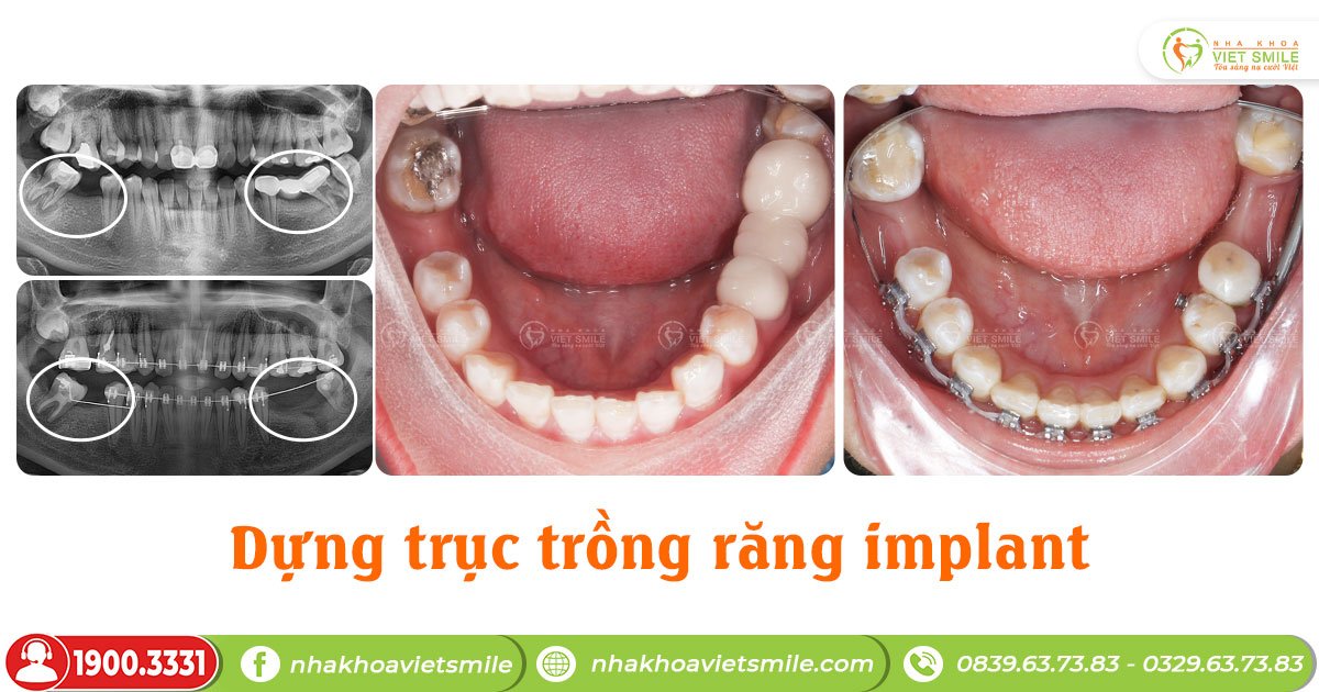 Dựng trục răng nghiêng