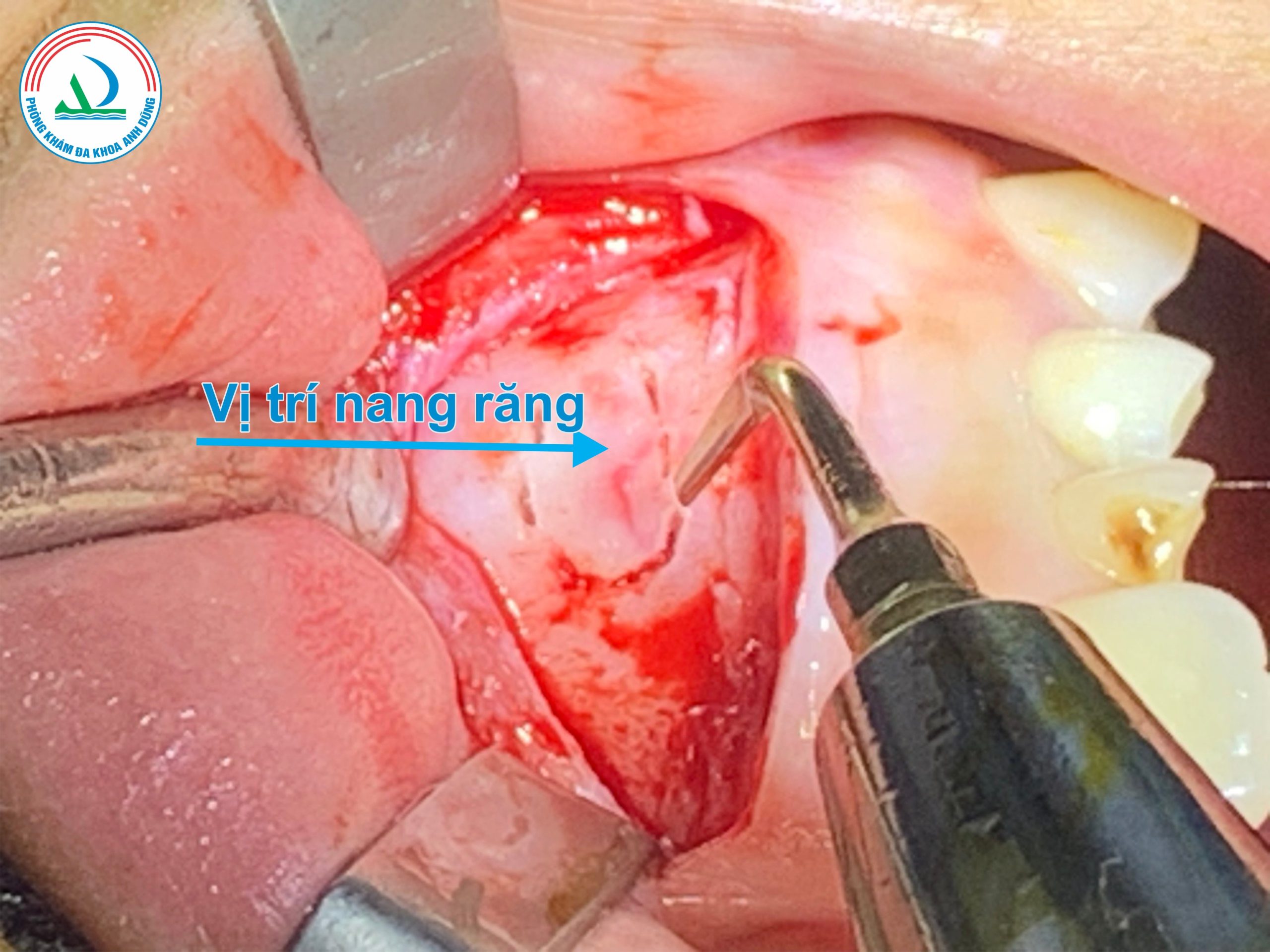 Phẫu thuật cắt chóp nạo nang